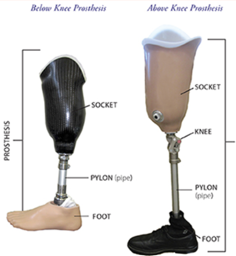 Prosthesis diagram